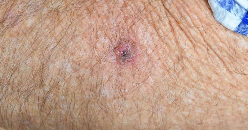 A doctor highlights one warning sign that could indicate a skin cancer lesion.