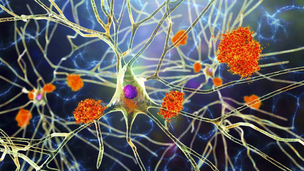 A new blood test for Alzheimer's is available. Here’s what you should know.