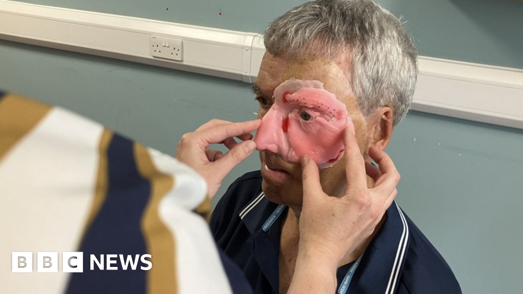 Cyclist receives 3D printed face following bike accident