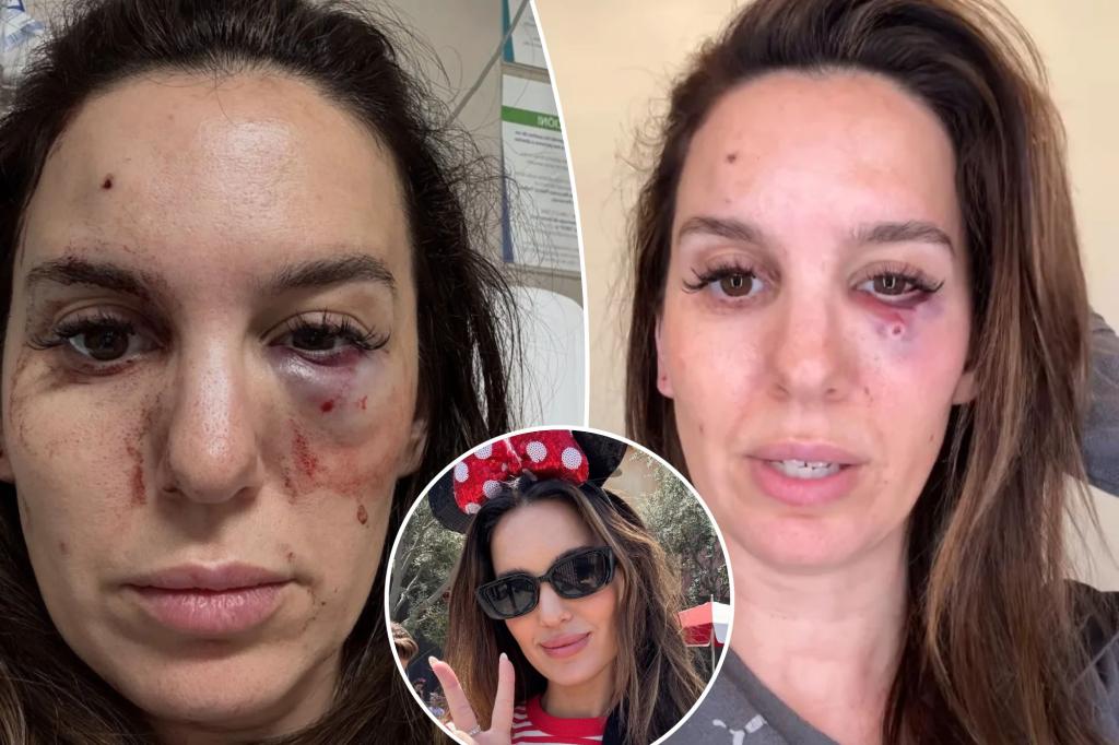Ex-Disney Channel star Christy Carlson Romano shares news after eye injury