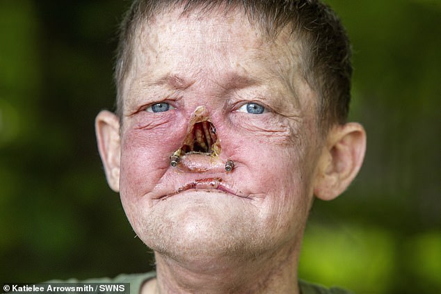 Man experiences an 'infection' that impacts everyone - it turned out to be deadly cancer that resulted in the loss of his NOSE