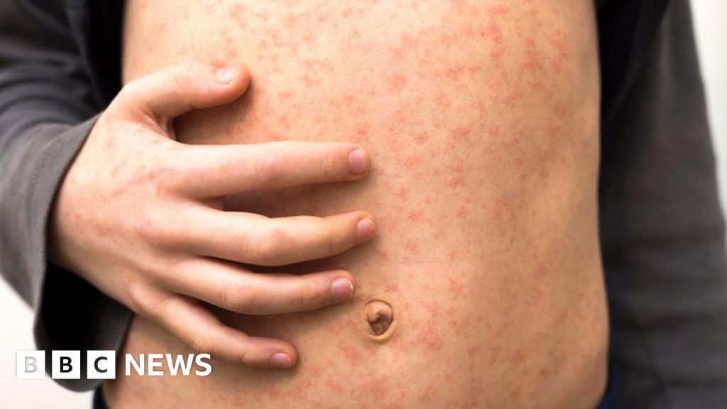 Measles alert for travelers as cases increase throughout Europe