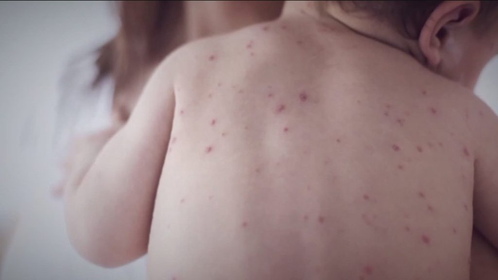 Measles case confirmed at Mall of America in Minnesota