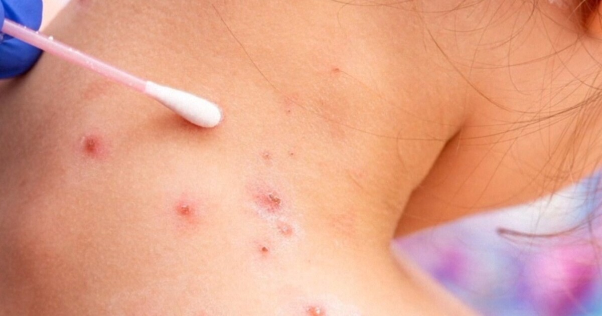 Measles exposure incident confirmed in Great Falls