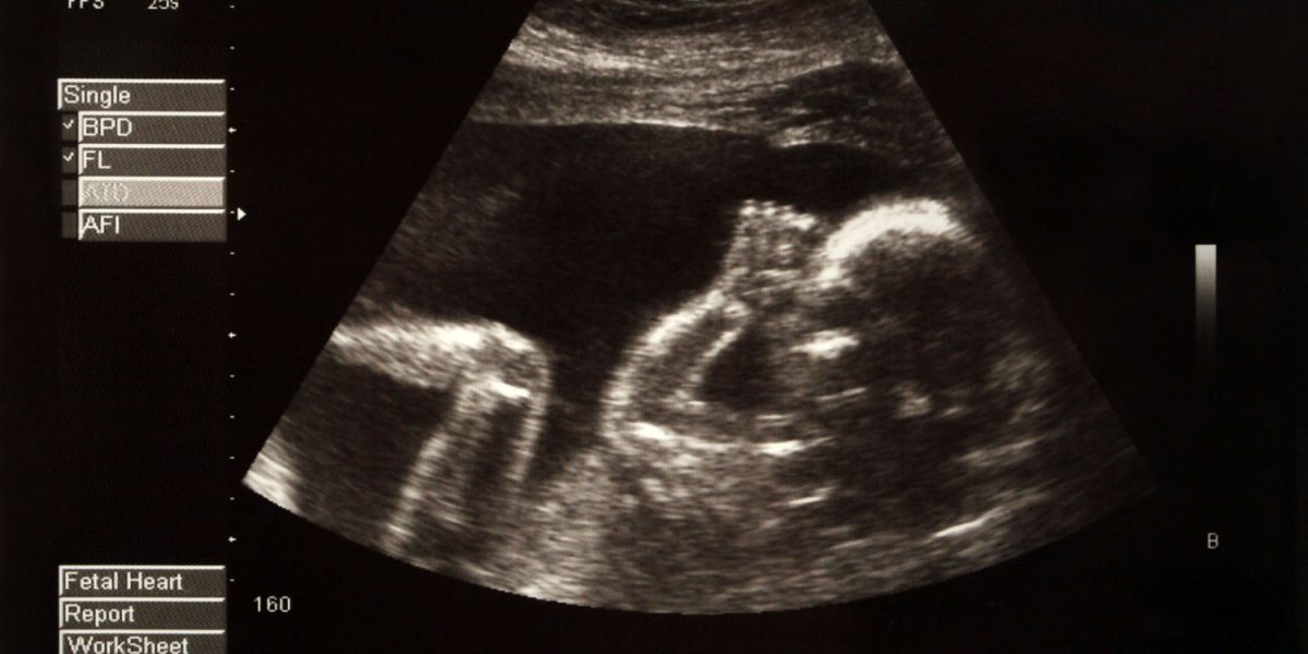 Most unmarried pregnant women believe the fetus looks like the father, study shows