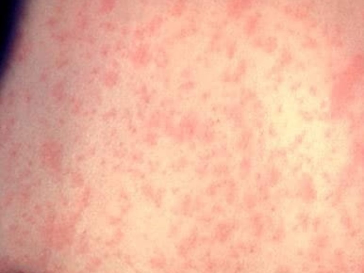 Oregon reports its first measles case of 2025, associated with overseas travel.
