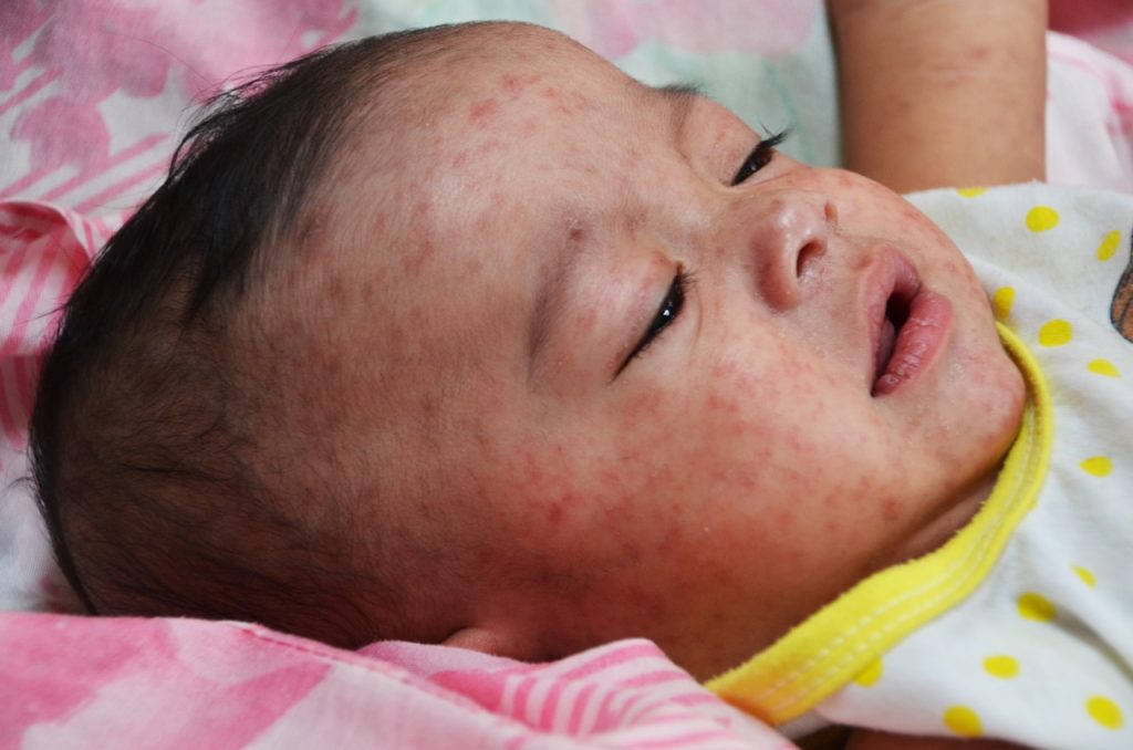Possible Measles Case in Alabama Prompting Investigation, Could Be the First in Years