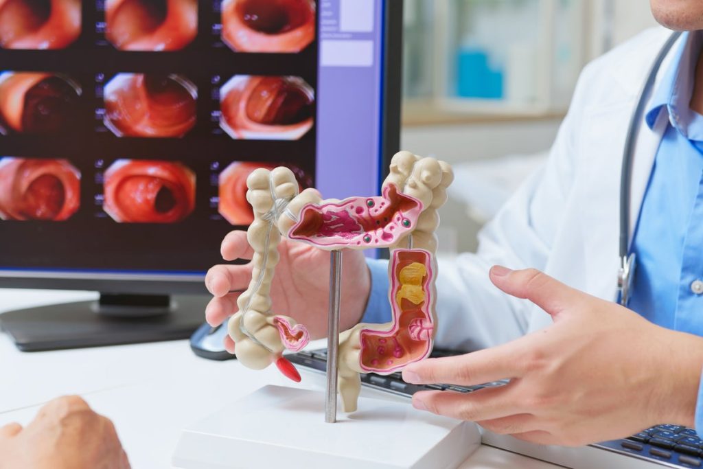 Researchers rejoice in bowel cancer advancement to address increase among younger individuals