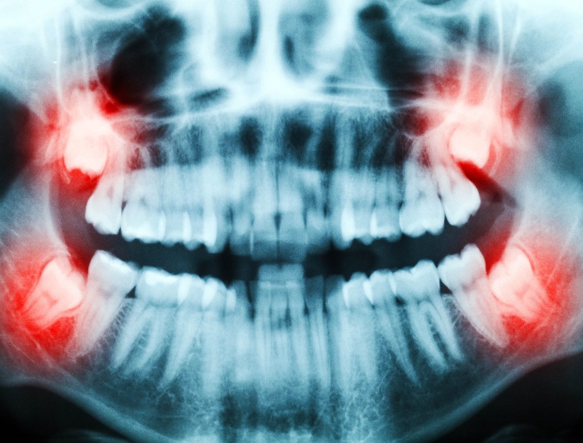 Stem cells from wisdom teeth may aid in treating various illnesses.