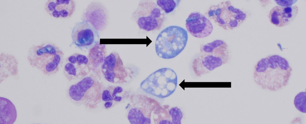 Texas Woman Passes Away Due to Brain-Eating Amoeba After Sinus Irrigation