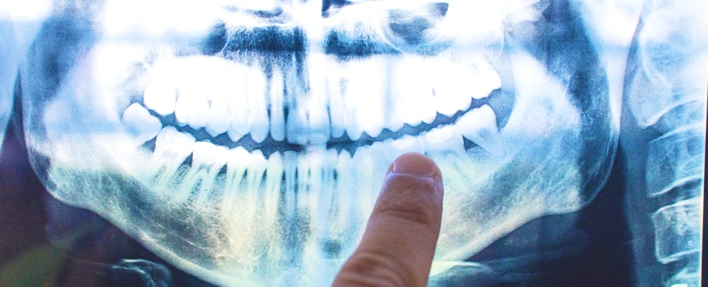 The Potential Link Between Alzheimer's and Oral Health