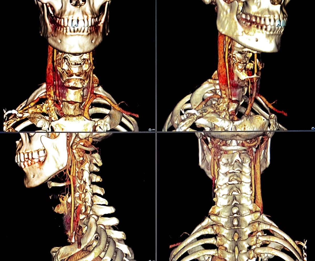This rarely discussed reason for strokes has risen by 400% since 2005.