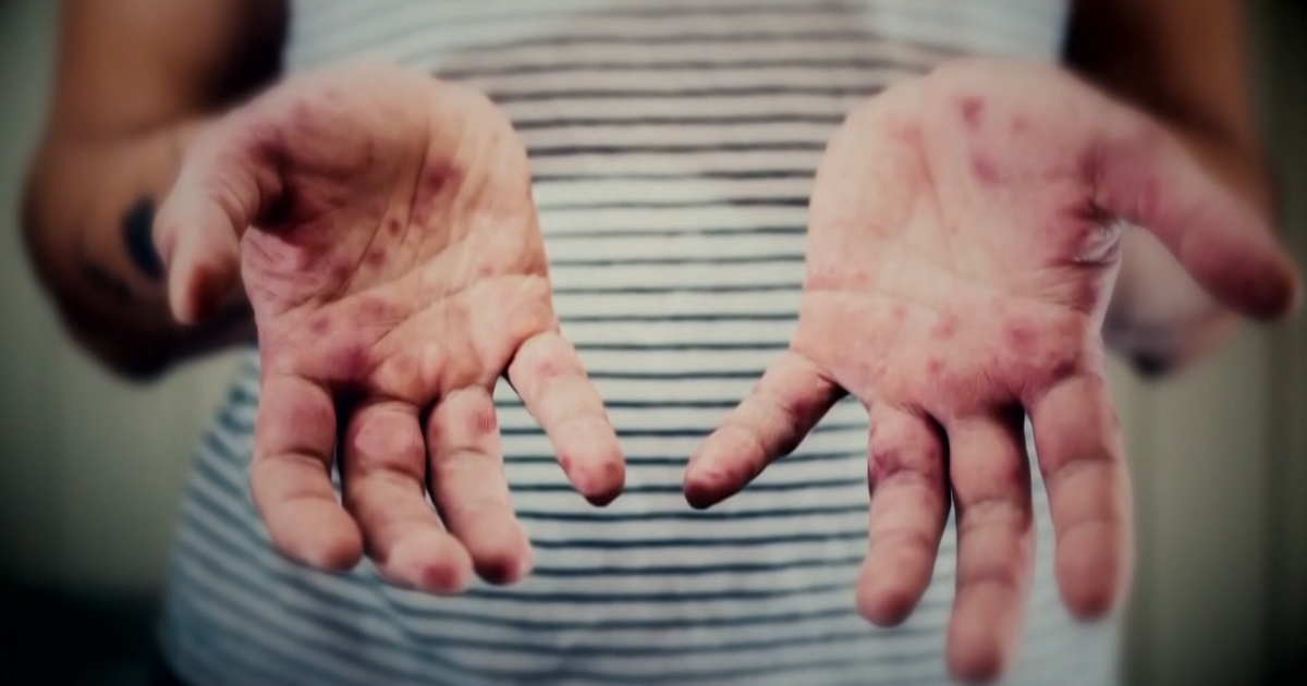 Triangle hospitals monitoring for measles patients following first case reported in NC