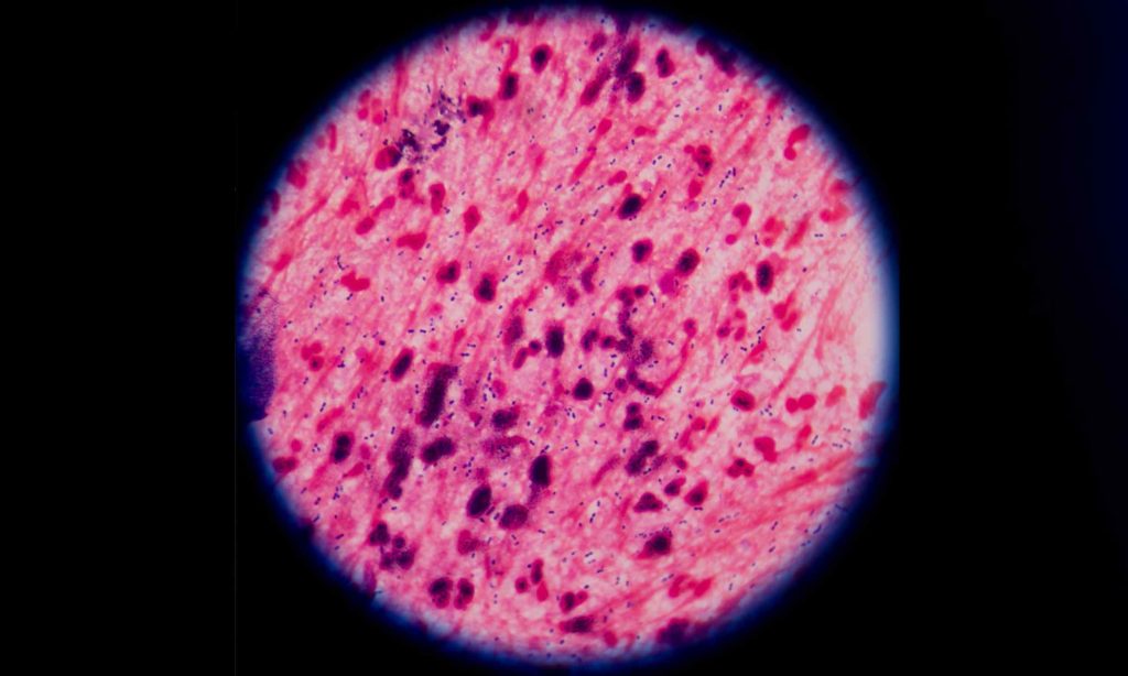 Typhoid fever is developing resistance to nearly all antibiotics.