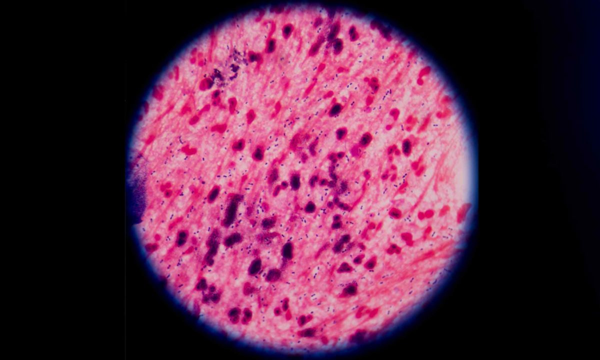 Typhoid fever is developing resistance to nearly all antibiotics.