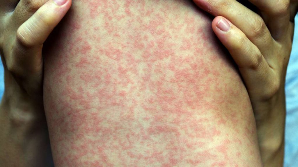 Utah health authorities watching for possible measles exposure in southwestern Utah