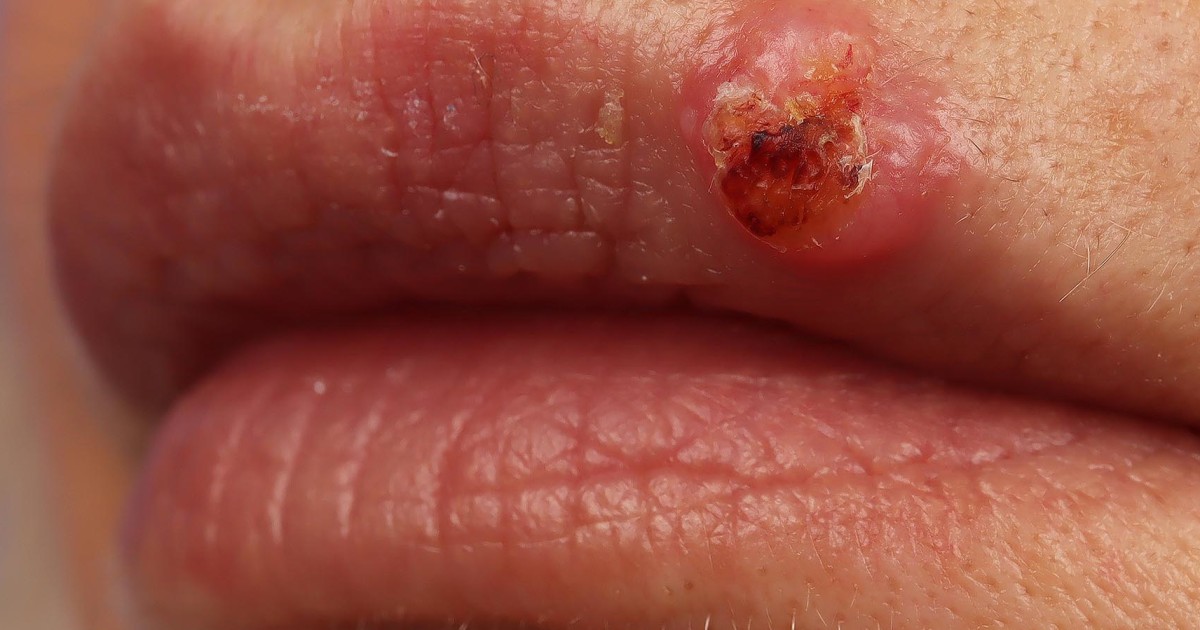 A specific strain of HPV has been identified as a cause of skin cancer, based on a recent report.