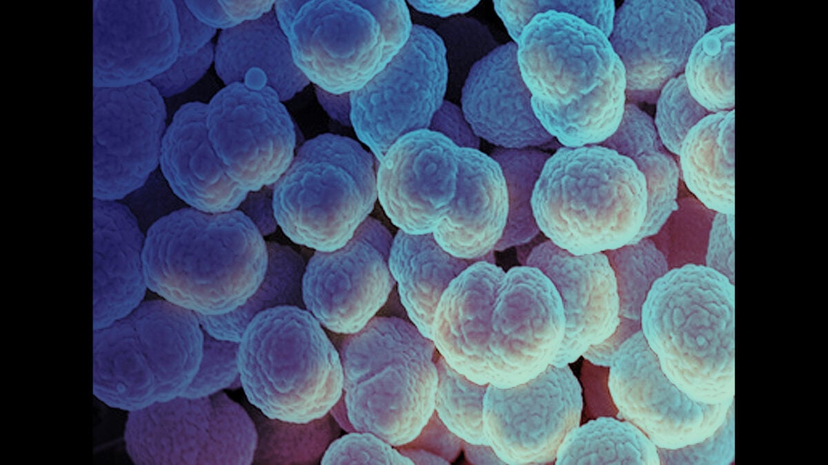 Death of Alaskan Woman From Gonorrhea Raises Concerns About a New Strain
