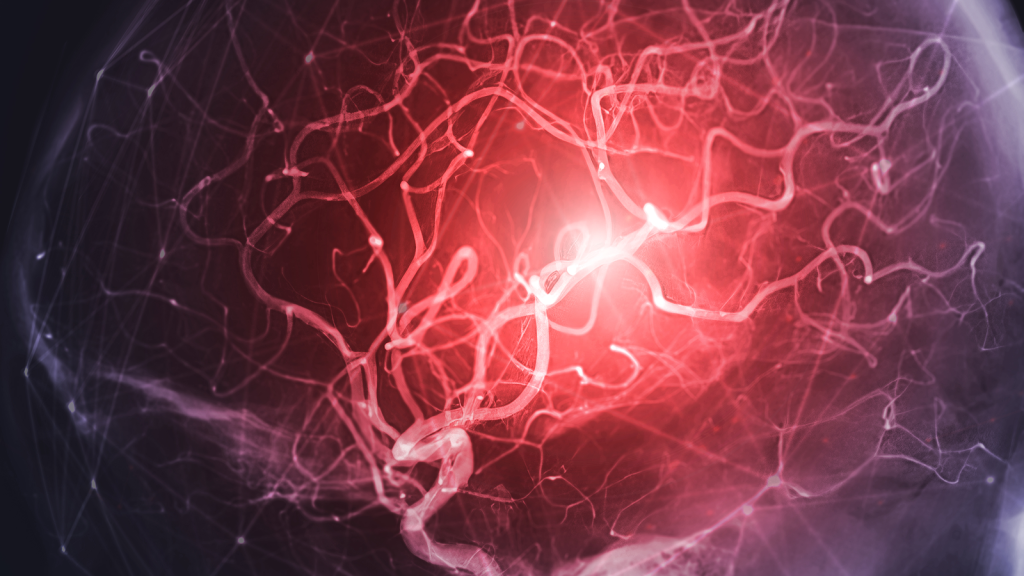 Diagnostic challenge: Orgasm with a kitchen whisk probably caused individual's deadly aneurysm