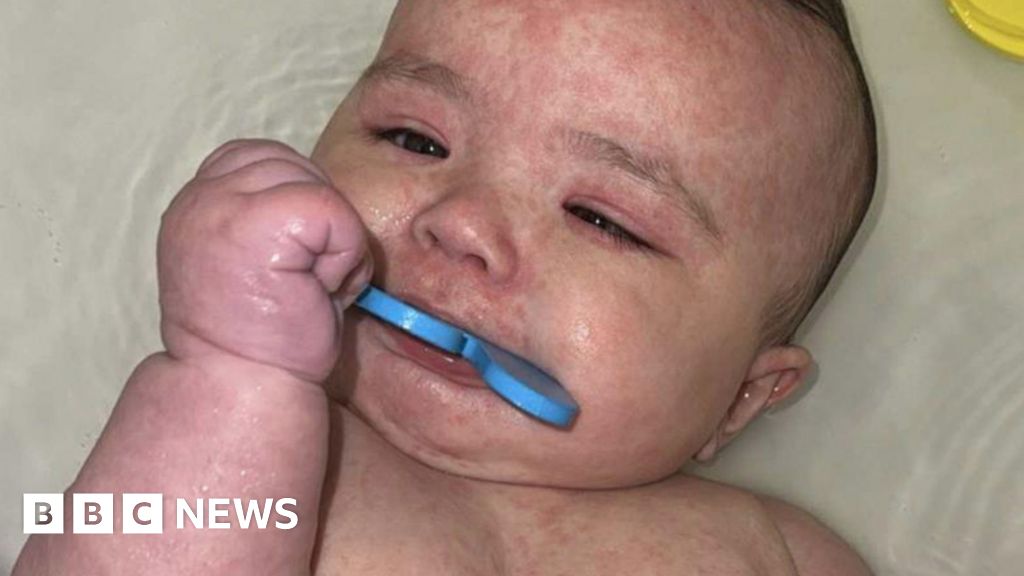 How Canada emerged as the focal point of a measles outbreak in North America