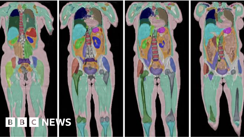 Largest human imaging study reaches 100,000 volunteers in the UK