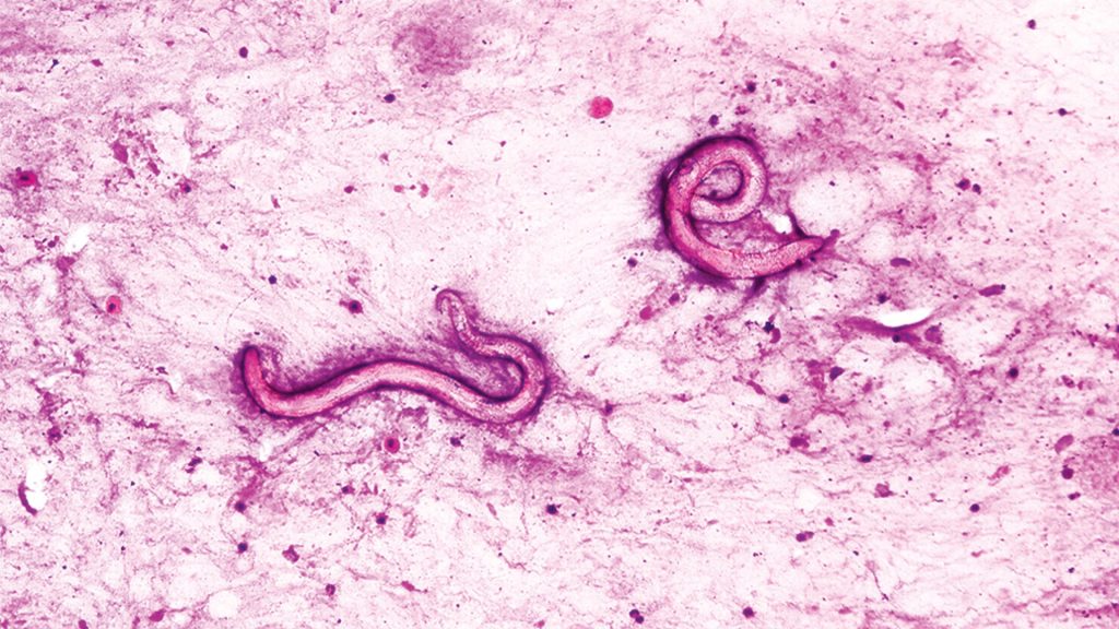Man's body infested with parasitic worms following infected kidney transplant in US hospital
