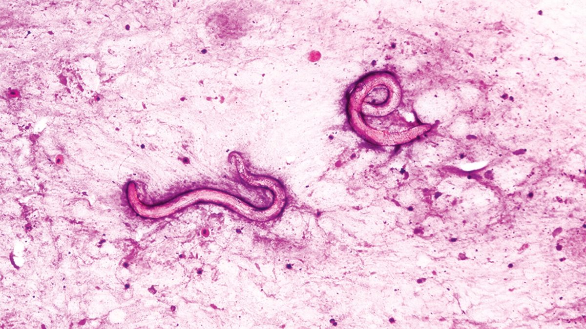 Man's body infested with parasitic worms following infected kidney transplant in US hospital