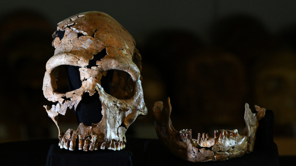 Neanderthal genes might account for a serious condition that causes the brain to protrude from the skull.