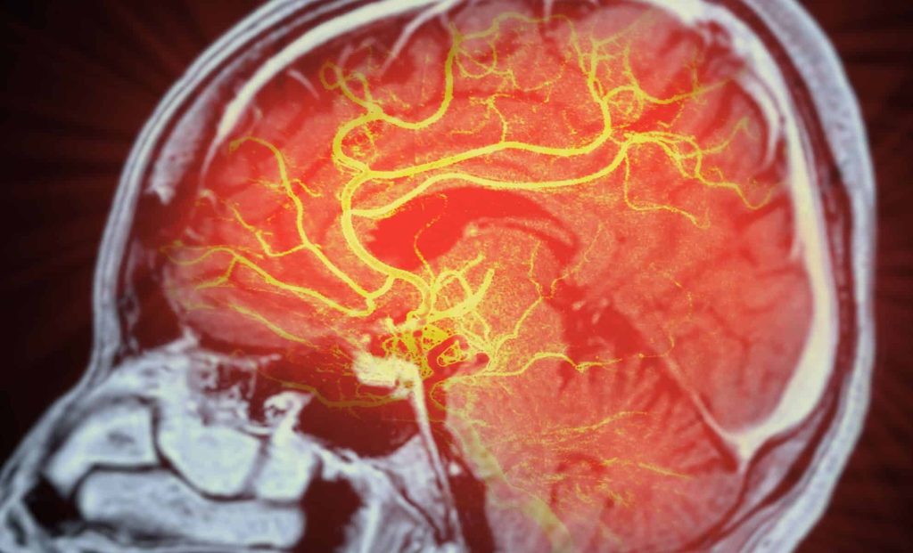 Research Suggests Two FDA-Approved Cancer Medications May Treat Alzheimer's