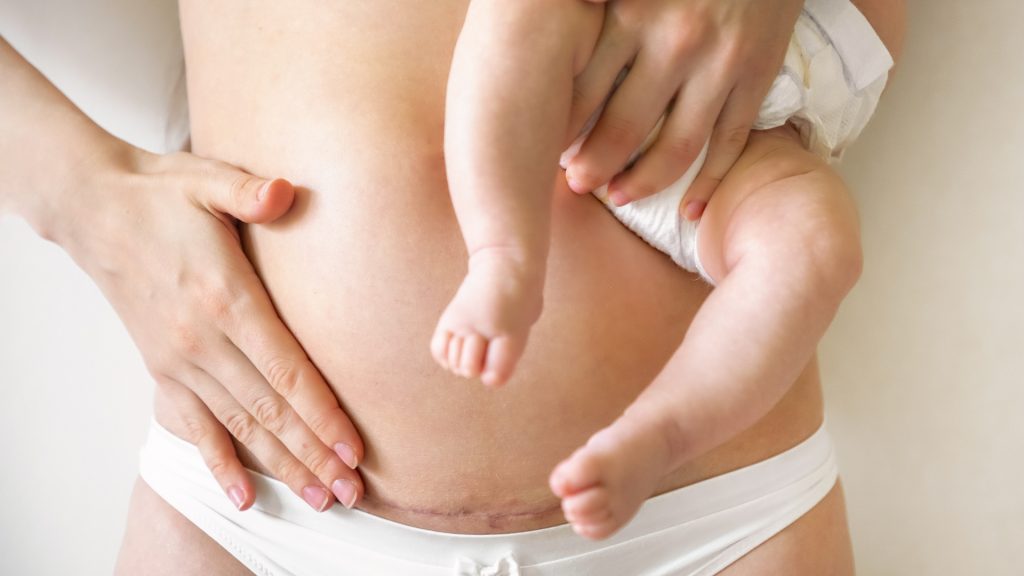 Scheduled C-sections associated with a higher risk of childhood leukemia, research shows