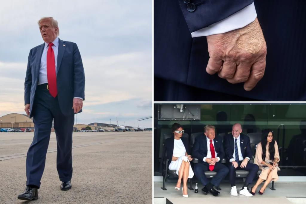 Trump experiencing ongoing leg swelling due to chronic venous insufficiency, according to the White House