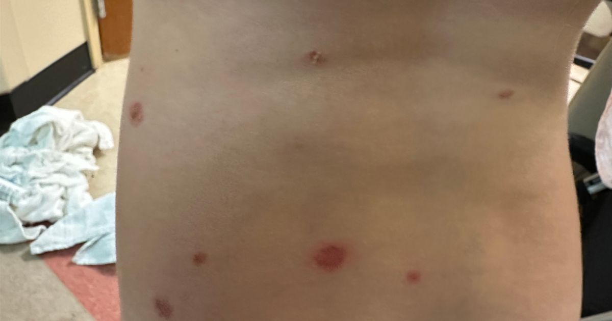 Uncommon, distressing skin condition leads to several children being hospitalized