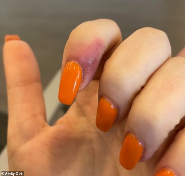 Woman says she got the herpes virus from a nail salon... the serious mistake she made
