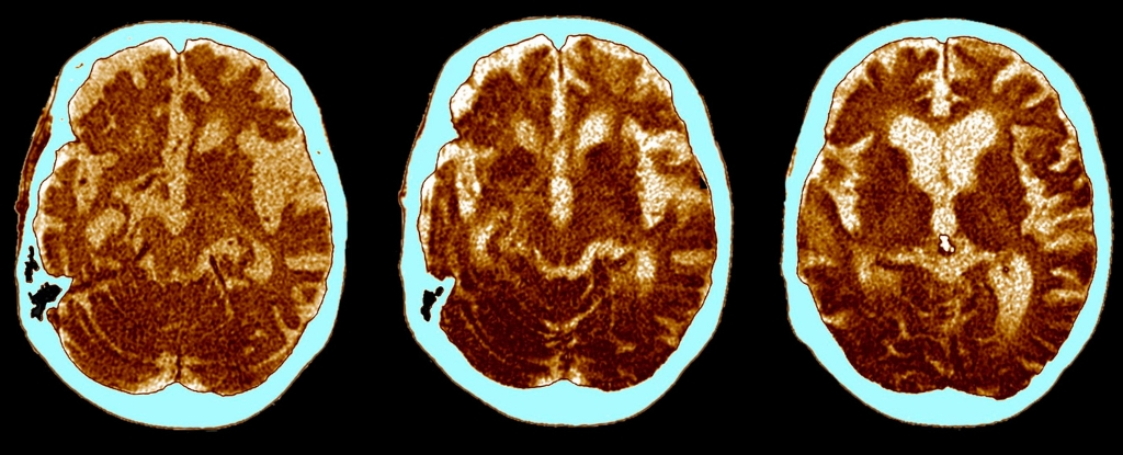 A Regular Vaccine Could Reduce the Risk of Dementia by Up to 20%