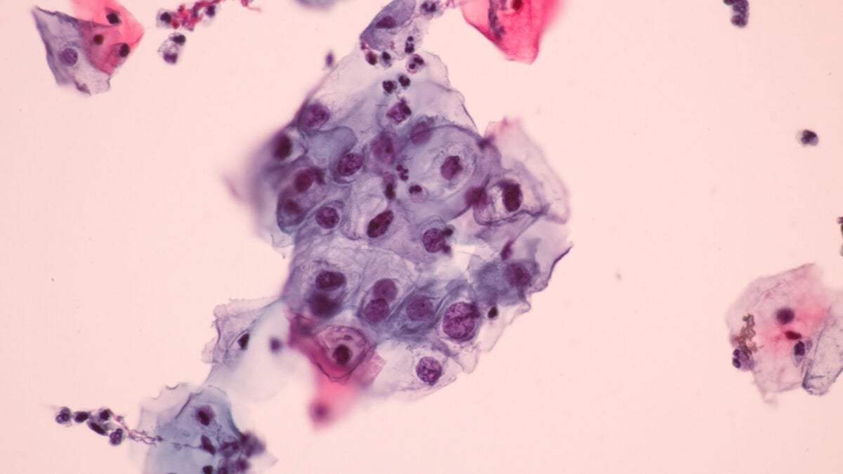 A Widespread Virus Leads to Cancer, Yet Many Americans Are Unaware