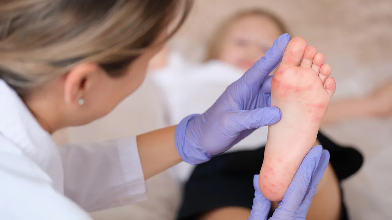 Cases of hand, foot, and mouth disease increasing in several regions of the US