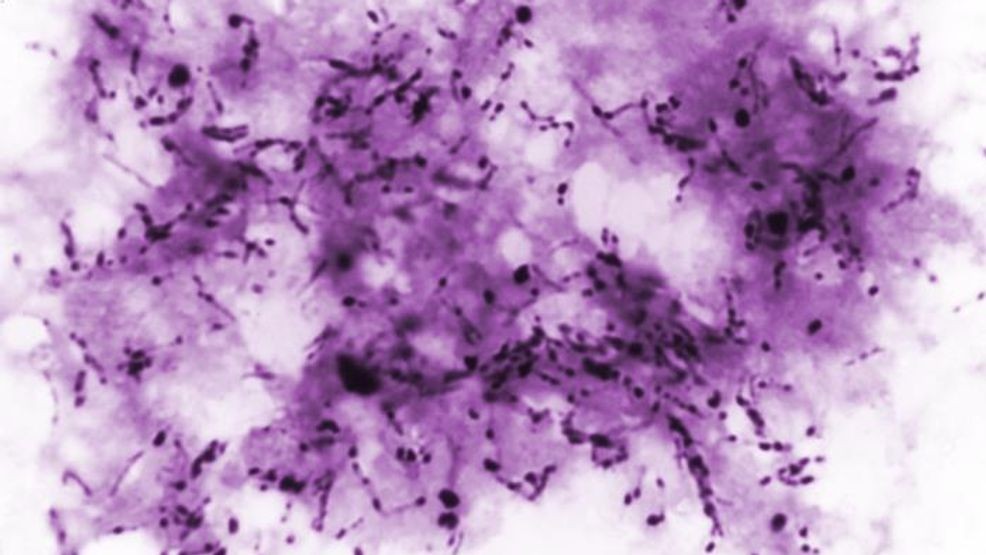 Confirmed tuberculosis case in Jackson County; investigation in progress