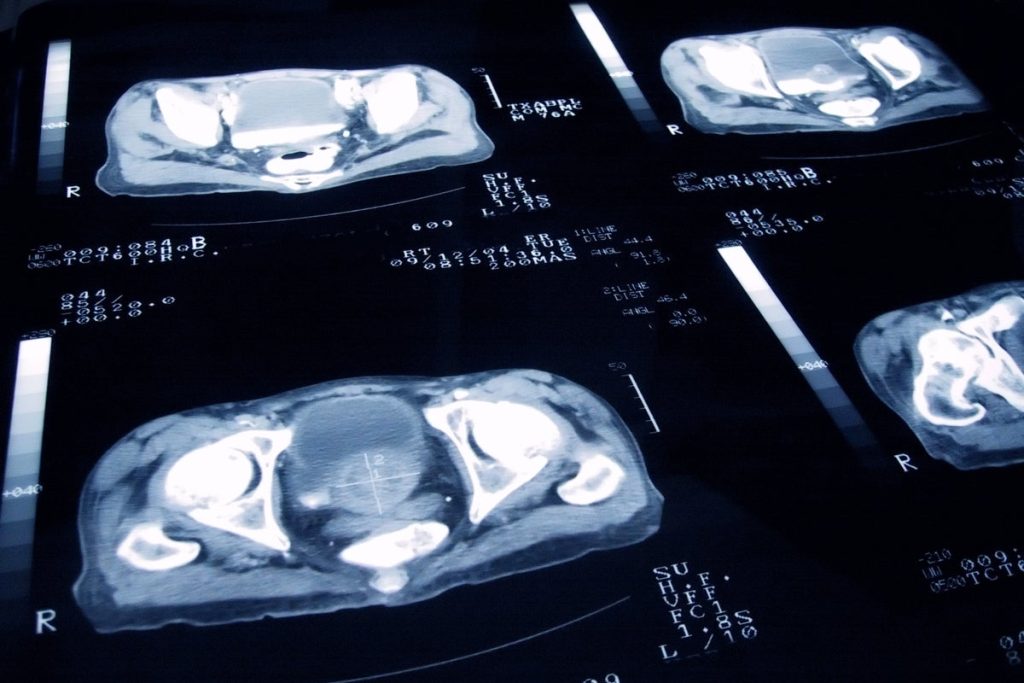 Experts caution that many men with prostate cancer are undergoing unnecessary treatment.