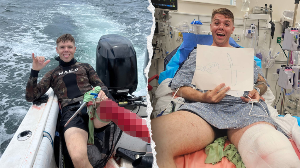 Florida spearfisherman endures bull shark bite and intends to go back to the water