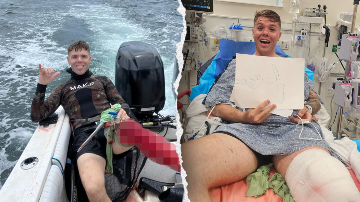 Florida spearfisherman endures bull shark bite and intends to go back to the water