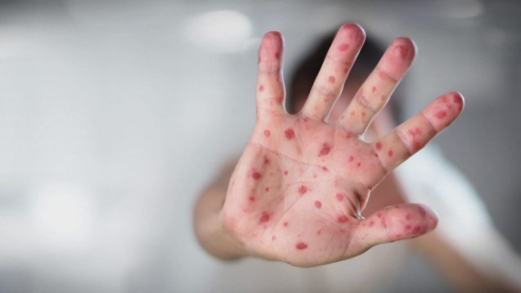 Idaho Panhandle Health District confirms its first measles case in more than three decades
