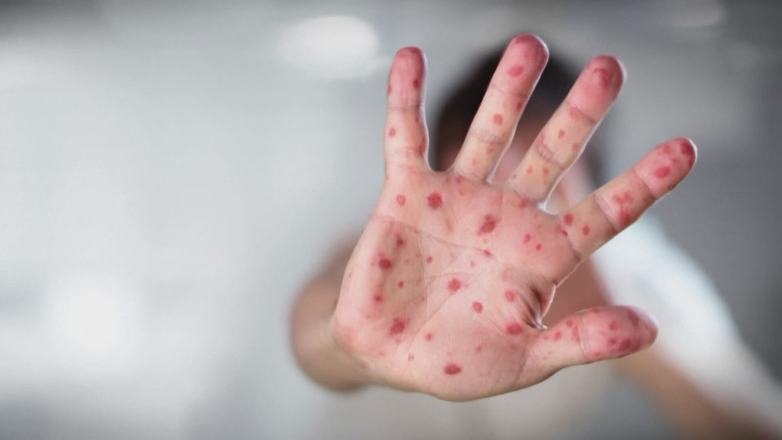 Idaho Panhandle Health District confirms its first measles case in more than three decades