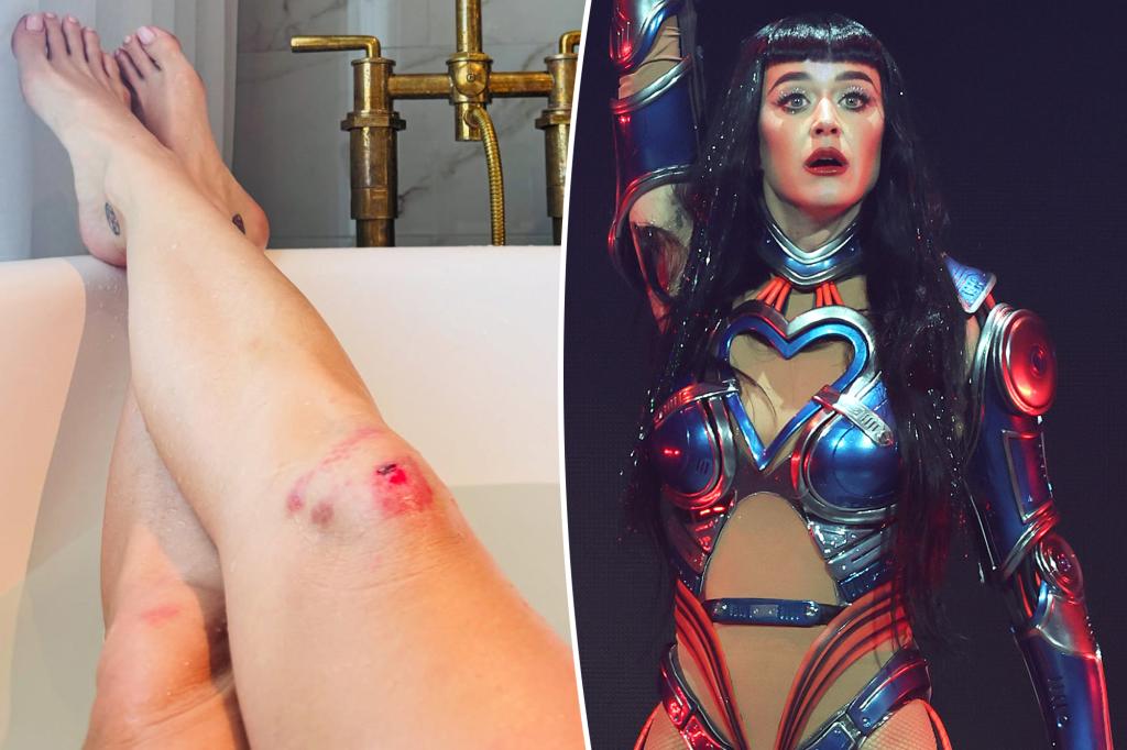 Katy Perry displays the harshly scraped knees she got while on tour for 'Lifetimes'