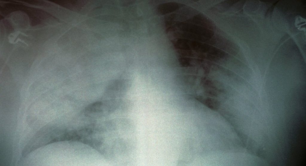 Legionnaires' disease affects Central Harlem. Here’s what you need to know about the outbreak.