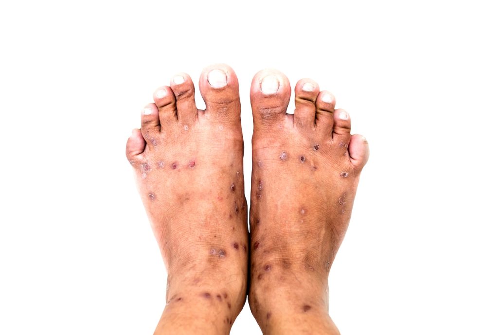 Medical professionals on Staten Island advise parents to be careful about this 'easily spread' illness.