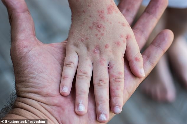 New York City gets ready for the spread of a second 'highly contagious' virus as cases extend to nearby states.