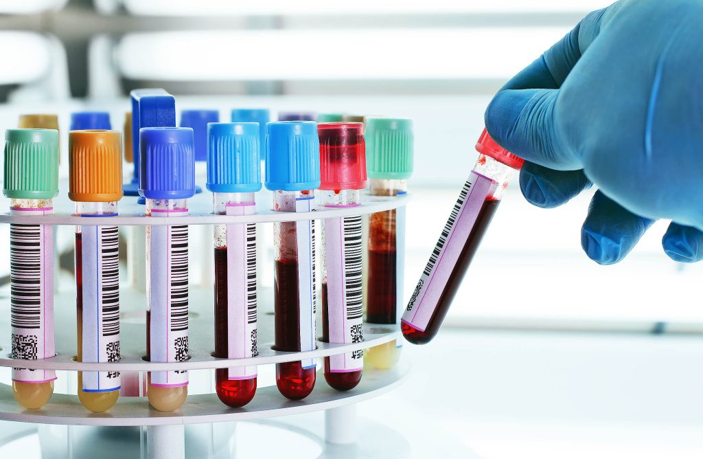 New blood test detects early Alzheimer's with 90% precision