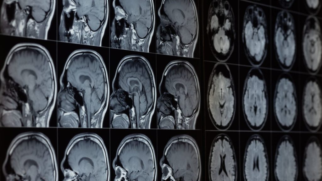 Research Suggests Lithium in Our Brains May Be Linked to Alzheimer's Disease Risk