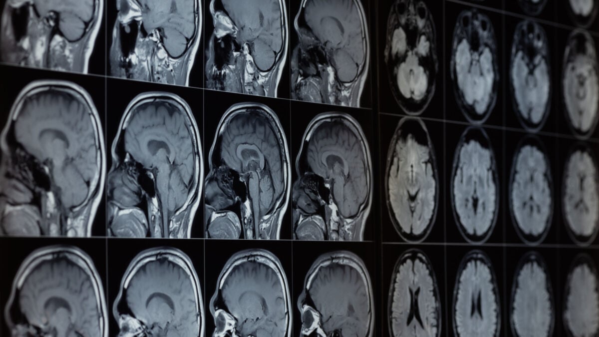 Research Suggests Lithium in Our Brains May Be Linked to Alzheimer's Disease Risk