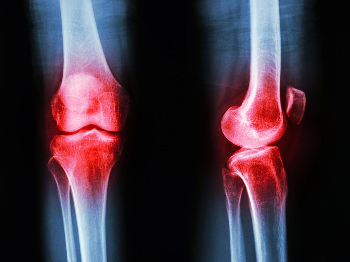 Researchers Find Easy Method to Alleviate Arthritis Discomfort